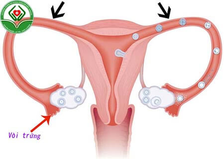 Tắc ống dẫn trứng là bệnh như thế nào