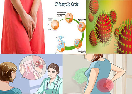 Biểu hiện bệnh chlamydia ở nữ như thế nào