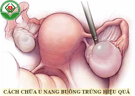 cách chữa u nang buồng trứng