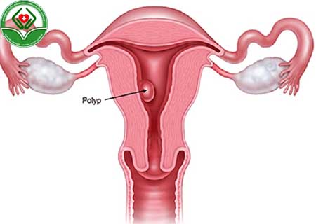 bệnh polyp cổ tử cung là gì