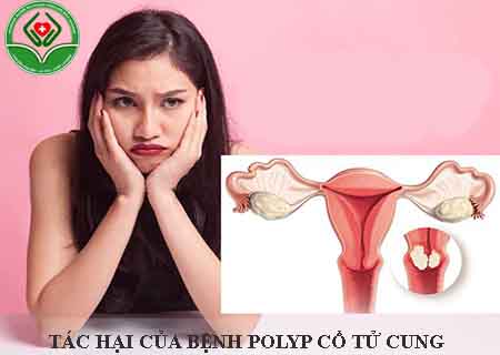 tác hại của bệnh polyp cổ tử cung