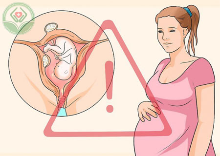 U xơ tử cung gây sảy thai cao