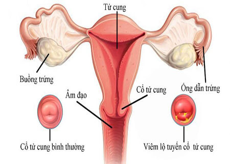 Viêm lộ tuyến cổ tử cung là bệnh như thế nào