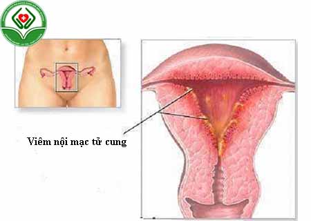 viêm nội mạc tử cung là gì