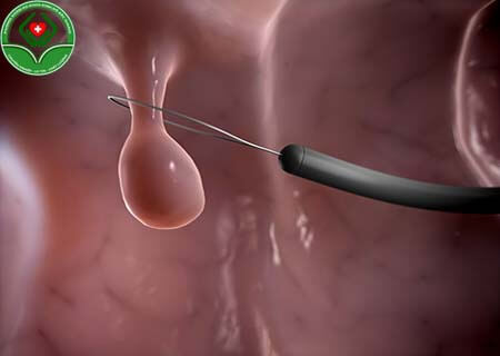 Các bước cắt polyp cổ tử cung