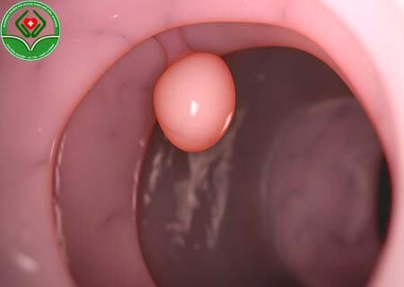 Xoắn polyp cổ tử cung là gì?