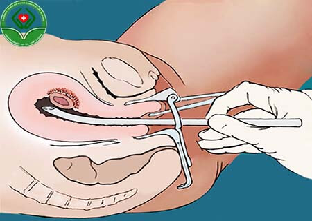 Phá thai bằng ống siêu dẫn