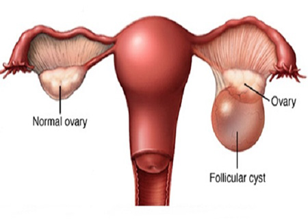 Hình ảnh u nang hoàng thể tại buồng trứng
