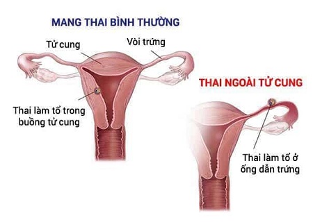 Tắc vòi trứng bên trái dẫn tới mang thai ngoài tử cung