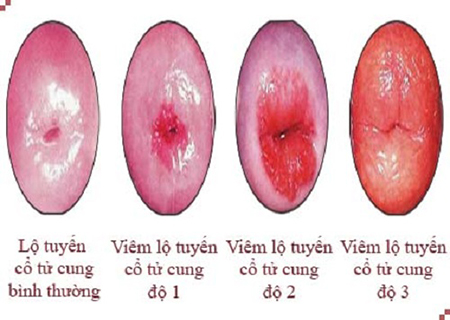 các giai đoạn của viêm lộ tuyến cổ tử cung