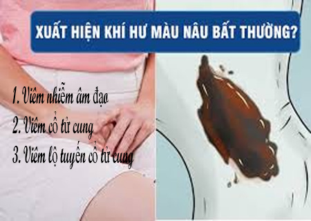 Viêm lộ tuyến cổ tử cung là dấu hiệu của nhiều bệnh