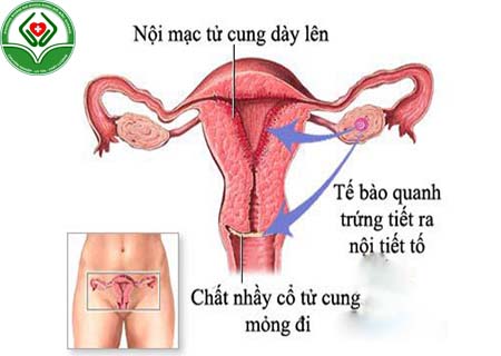 Bệnh viêm nội mạc tử cung