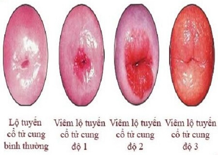 viem-lo-tuyen-do-3-nang