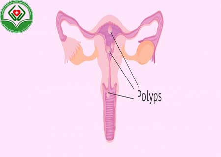 Xoắn polyp cổ tử cung là gì?